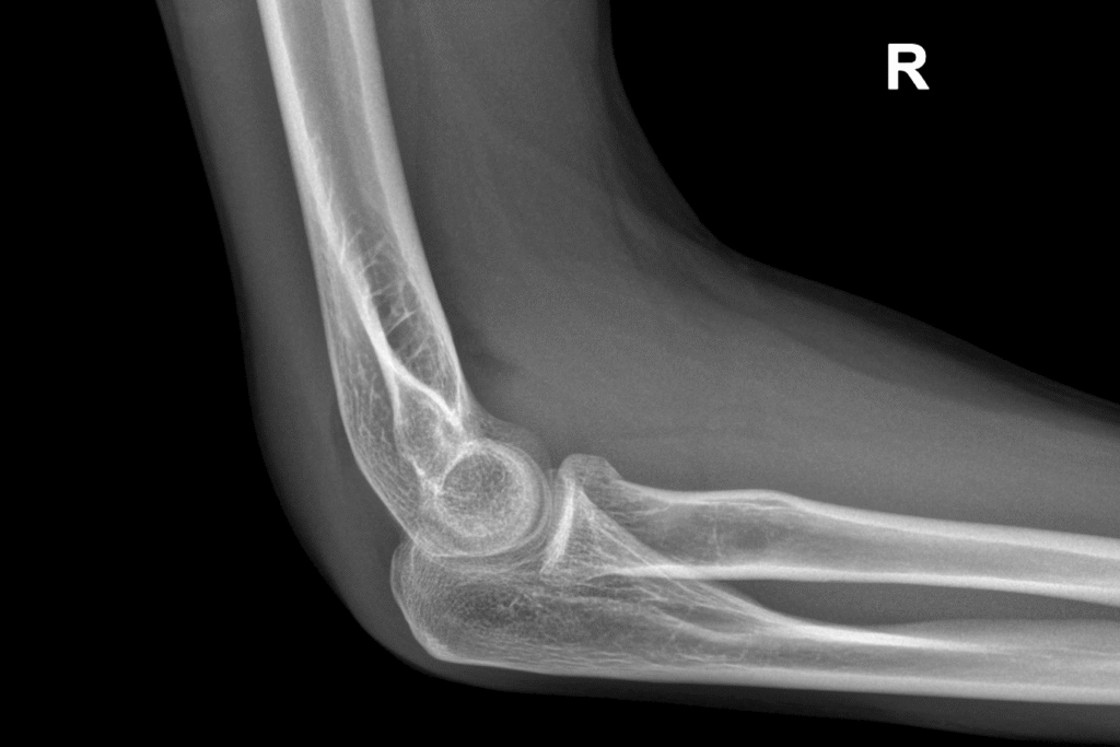 Radiografia del gomito