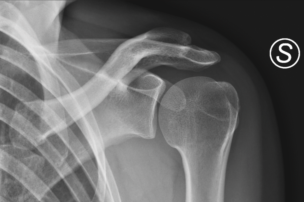 Radiografia della spalla